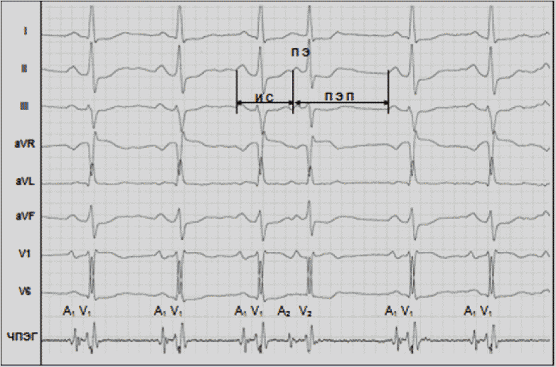 Суправентрикулярная экстрасистолия на ЭКГ. ЭКГ синдром наджелудочкового гребешка. Наджелудочковый гребешок на ЭКГ. Наджелудочковая экстрасистолия мкб 10.