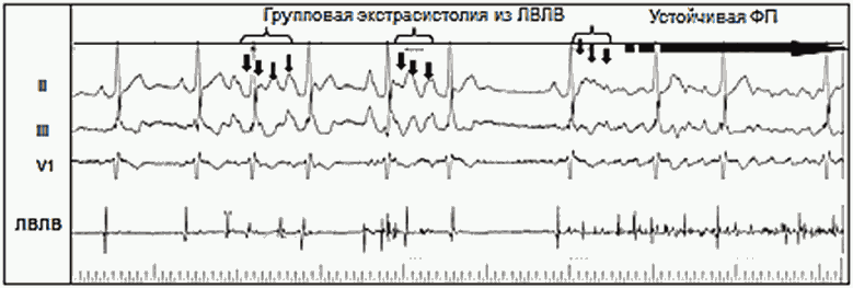 Пароксизм фп карта вызова